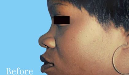 Rhinoplasty Before & After Patient #2973