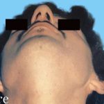 Rhinoplasty Male Before & After Patient #3018