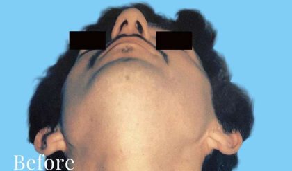 Rhinoplasty Male Before & After Patient #3018
