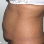 Tummy Tuck Before & After Patient #3060