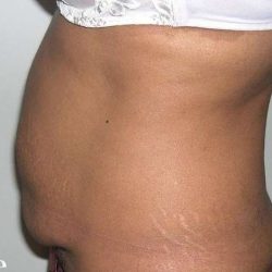 Tummy Tuck Before & After Patient #3060