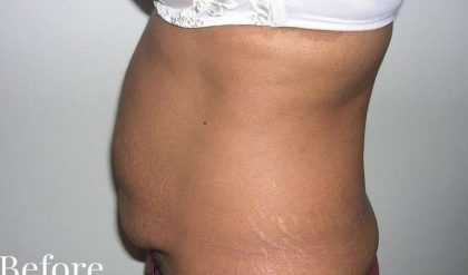 Tummy Tuck Before & After Patient #3060