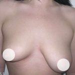 Breast Asymmetry Correction Before & After Patient #2178