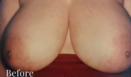 Breast Reduction Before & After Patient #2329
