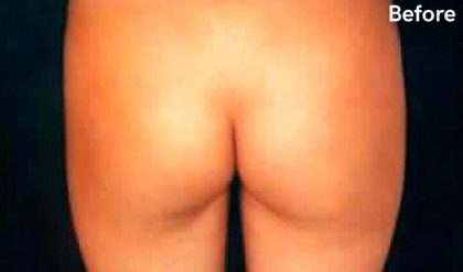 Buttock Augmentation Before & After Patient #2411