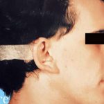 Otoplasty Male Before & After Patient #2538