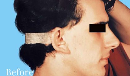 Otoplasty Male Before & After Patient #2538