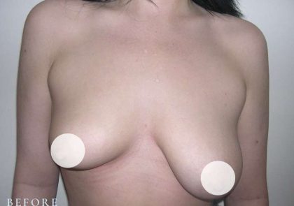 Breast Asymmetry Correction Before & After Patient #2178