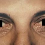 Eyelid Surgery Before & After Patient #2614
