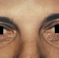 Eyelid Surgery Before & After Patient #2614