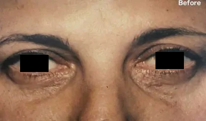 Eyelid Surgery Before & After Patient #2614