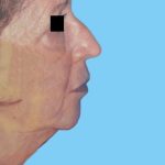 Facelift Before & After Patient #2650