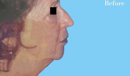 Facelift Before & After Patient #2650