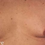 Gynecomastia Before & After Patient #2713