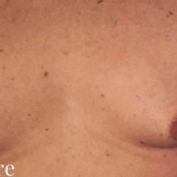 Gynecomastia Before & After Patient #2713