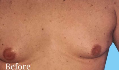 Gynecomastia Before & After Patient #2713