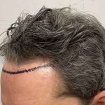 Hair Restoration Before & After Patient #2760