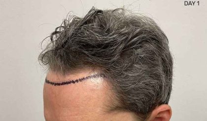 Hair Restoration Before & After Patient #2760