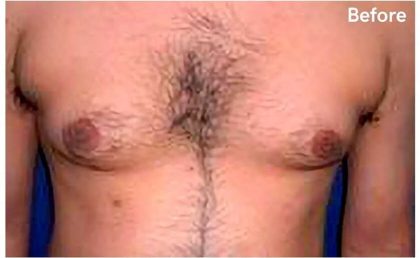 Daddy Makeover Before & After Patient #2516