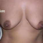 Breast Lift Before & After Patient #2278