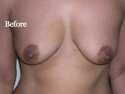 Breast Lift Before & After Patient #2278