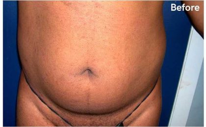 Daddy Makeover Before & After Patient #2516