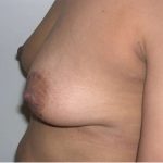 Breast Lift Before & After Patient #2278
