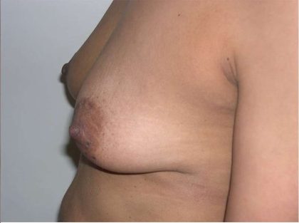 Breast Lift Before & After Patient #2278