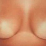 Breast Augmentation Before & After Patient #2210