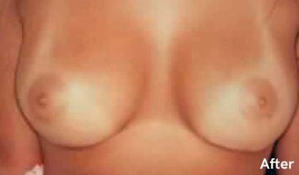 Breast Augmentation Before & After Patient #2210