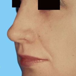 Rhinoplasty Before & After Patient #2964