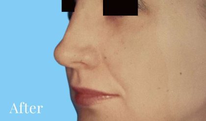 Rhinoplasty Before & After Patient #2964