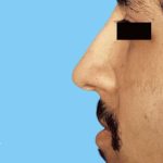 Rhinoplasty Male Before & After Patient #3018