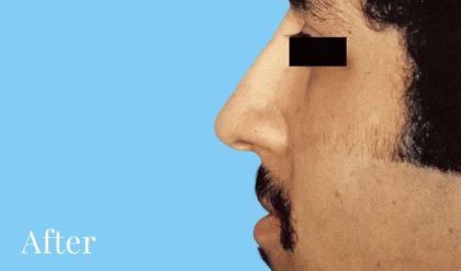 Rhinoplasty Male Before & After Patient #3018