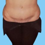 Tummy Tuck Before & After Patient #3051