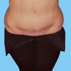 Tummy Tuck Before & After Patient #3051