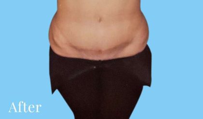 Tummy Tuck Before & After Patient #3051