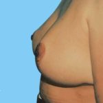Breast Reduction Before & After Patient #2320