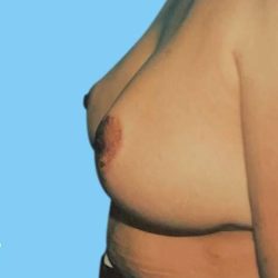 Breast Reduction Before & After Patient #2320