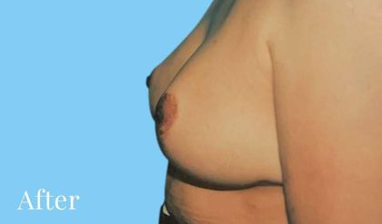 Breast Reduction Before & After Patient #2320