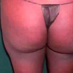 Buttock Augmentation Before & After Patient #2399