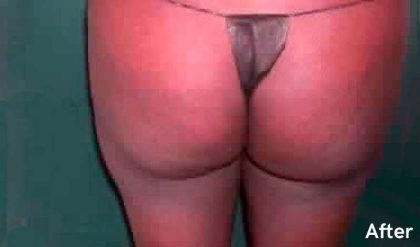 Buttock Augmentation Before & After Patient #2399