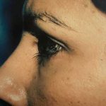 Eyelid Surgery Before & After Patient #2605