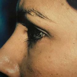 Eyelid Surgery Before & After Patient #2605