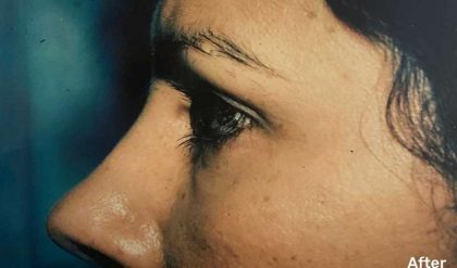 Eyelid Surgery Before & After Patient #2605