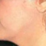 Facelift Before & After Patient #2641