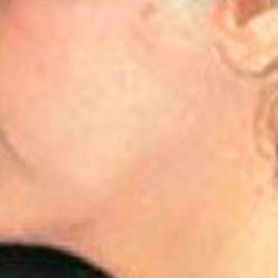 Facelift Before & After Patient #2641