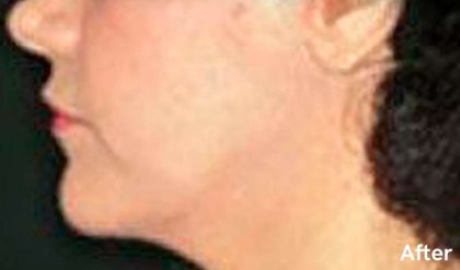 Facelift Before & After Patient #2641