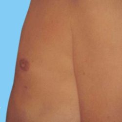 Gynecomastia Before & After Patient #2704