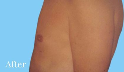 Gynecomastia Before & After Patient #2704